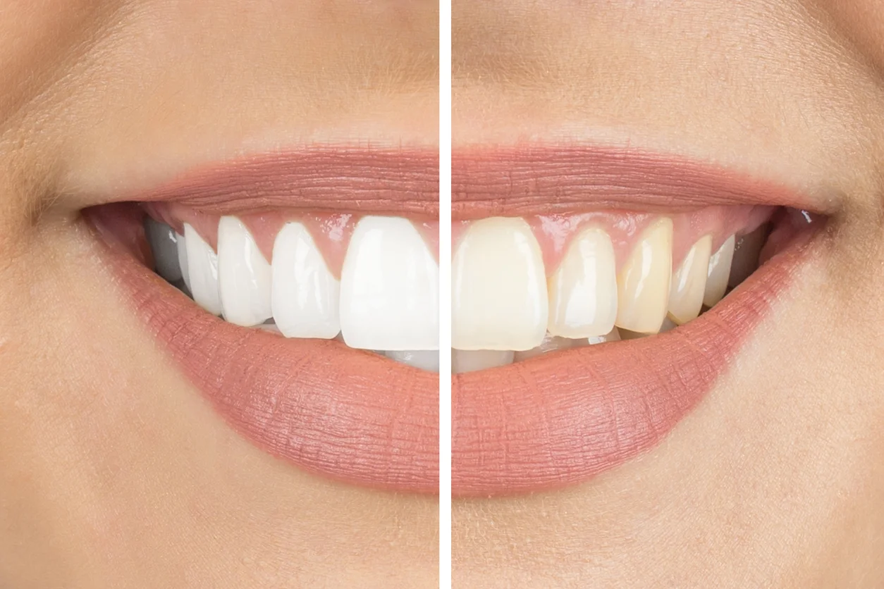 Teeth Whitening Cost in Dubai: What You Should Know First